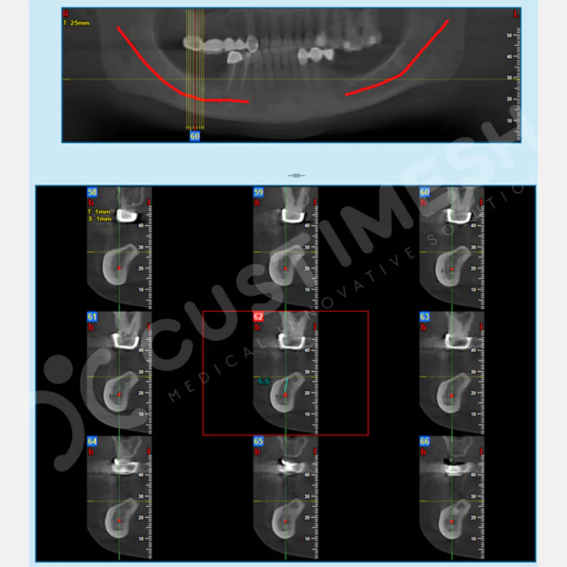 custimesh-mesh-titaniummesh-vaka1-1