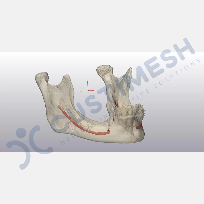 custimesh-mesh-titaniummesh-vaka1-10
