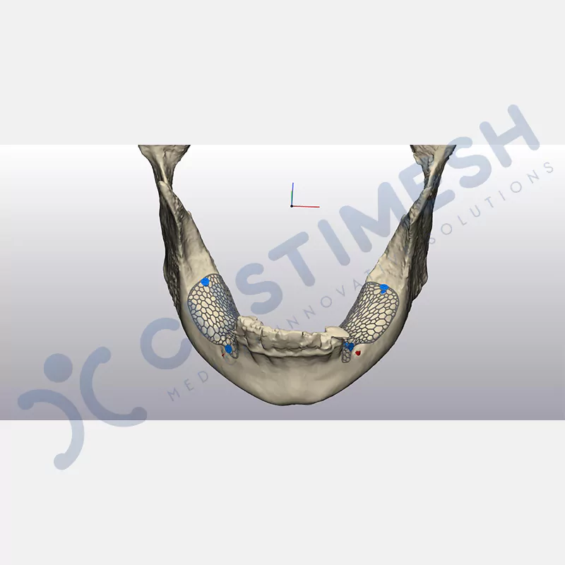 custimesh-mesh-titaniummesh-vaka1-11
