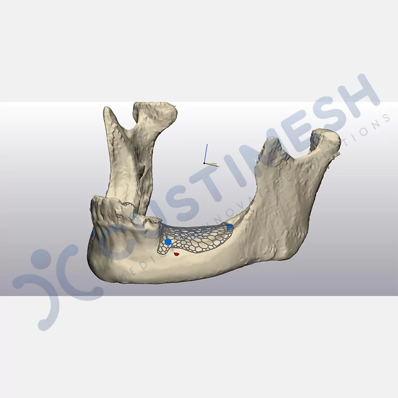 custimesh-mesh-titaniummesh-vaka1-12