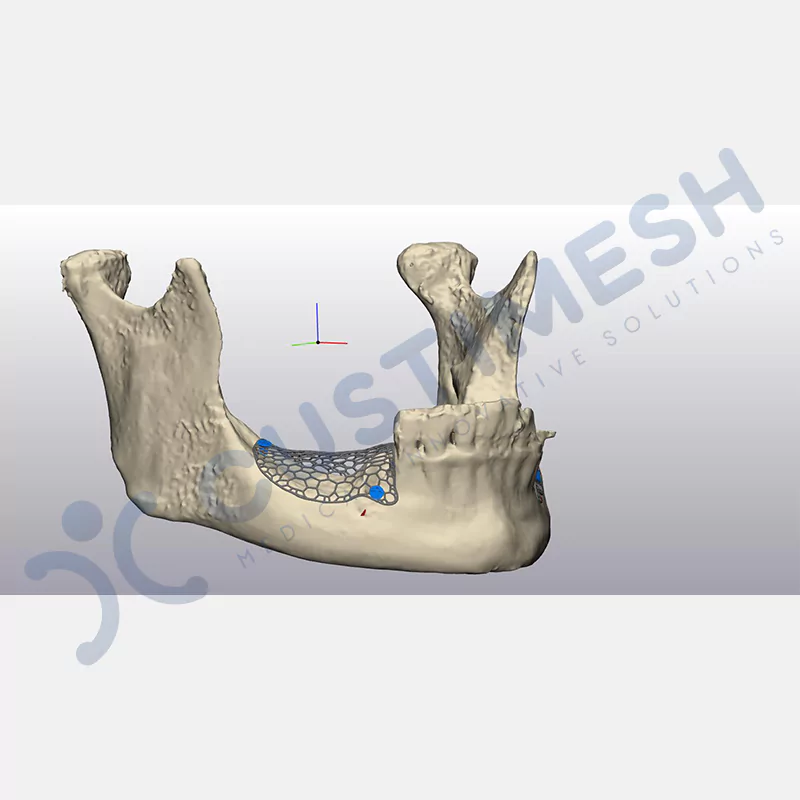 custimesh-mesh-titaniummesh-vaka1-13