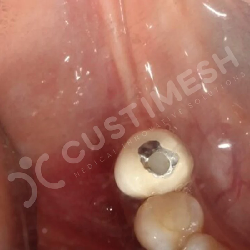 custimesh-mesh-titaniummesh-vaka1-15