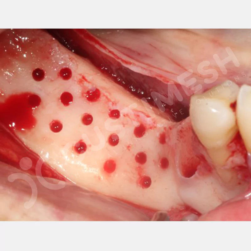 custimesh-mesh-titaniummesh-vaka1-16