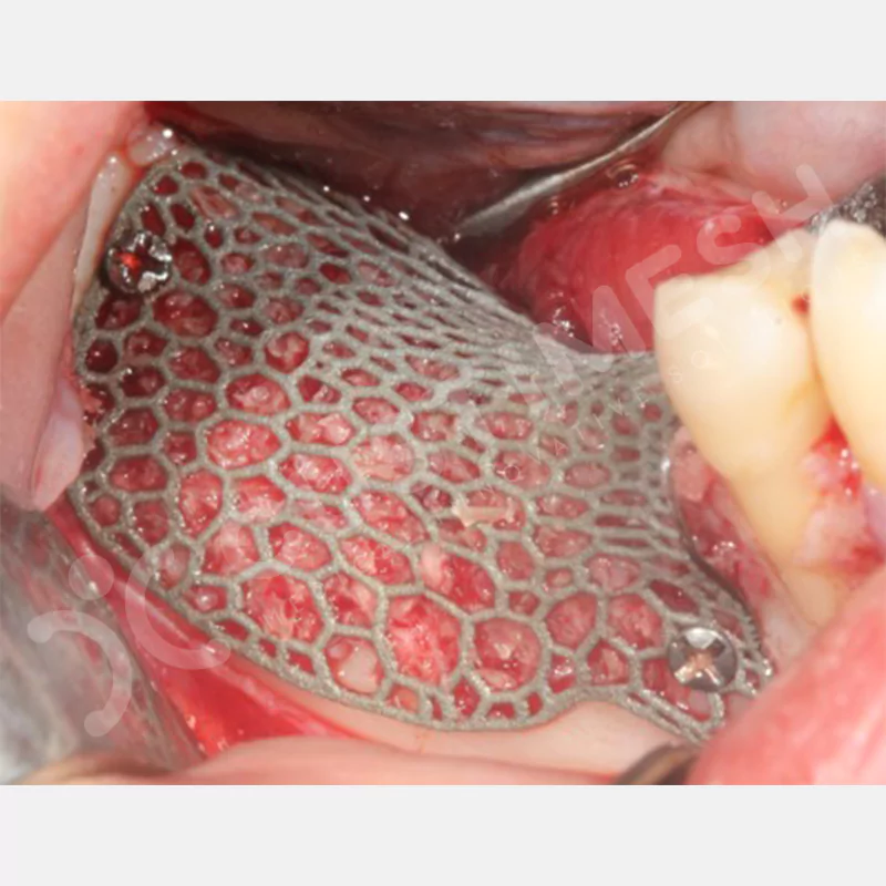 custimesh-mesh-titaniummesh-vaka1-19