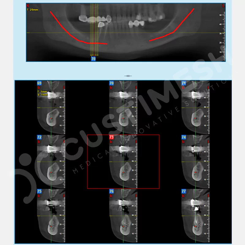custimesh-mesh-titaniummesh-vaka1-2