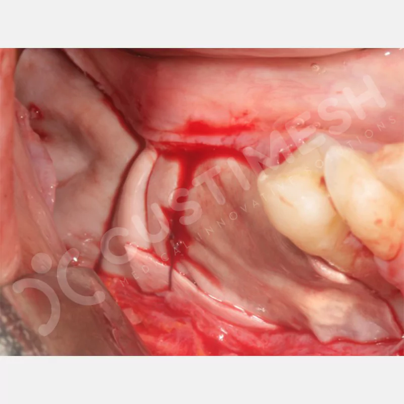 custimesh-mesh-titaniummesh-vaka1-20