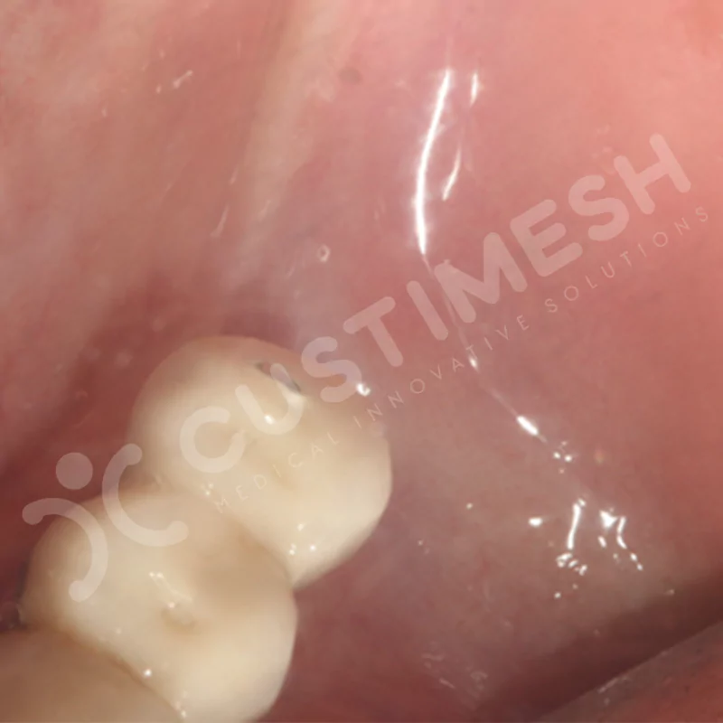 custimesh-mesh-titaniummesh-vaka1-21