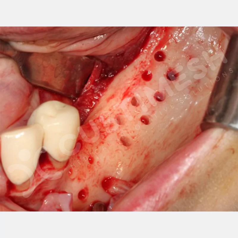 custimesh-mesh-titaniummesh-vaka1-22