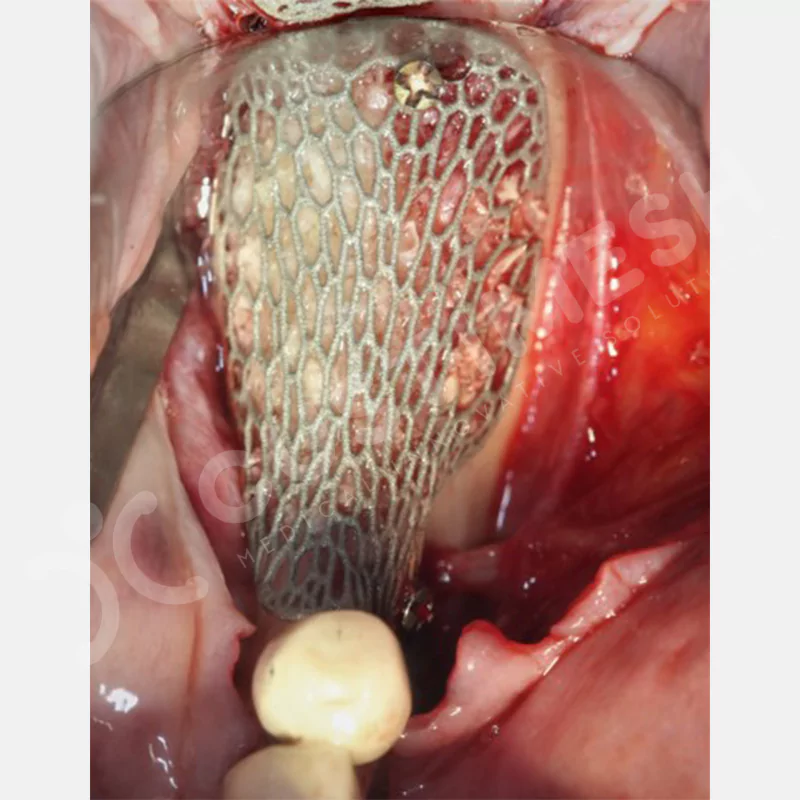 custimesh-mesh-titaniummesh-vaka1-24