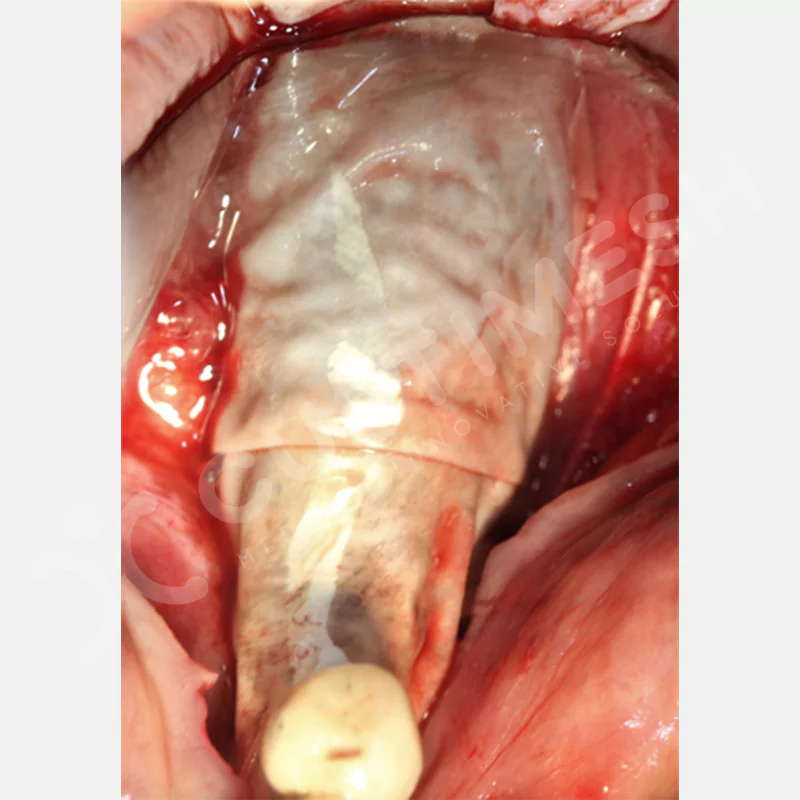 custimesh-mesh-titaniummesh-vaka1-25