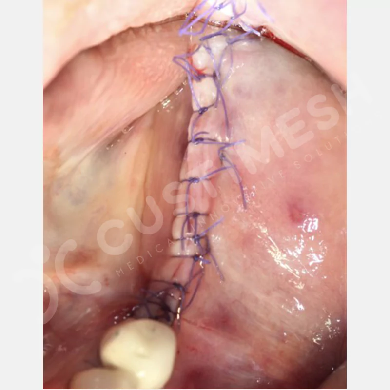 custimesh-mesh-titaniummesh-vaka1-26