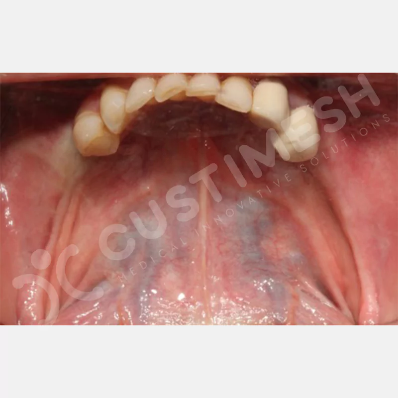 custimesh-mesh-titaniummesh-vaka1-27