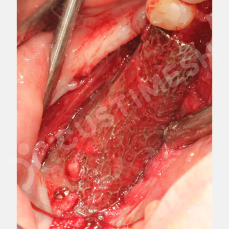 custimesh-mesh-titaniummesh-vaka1-28