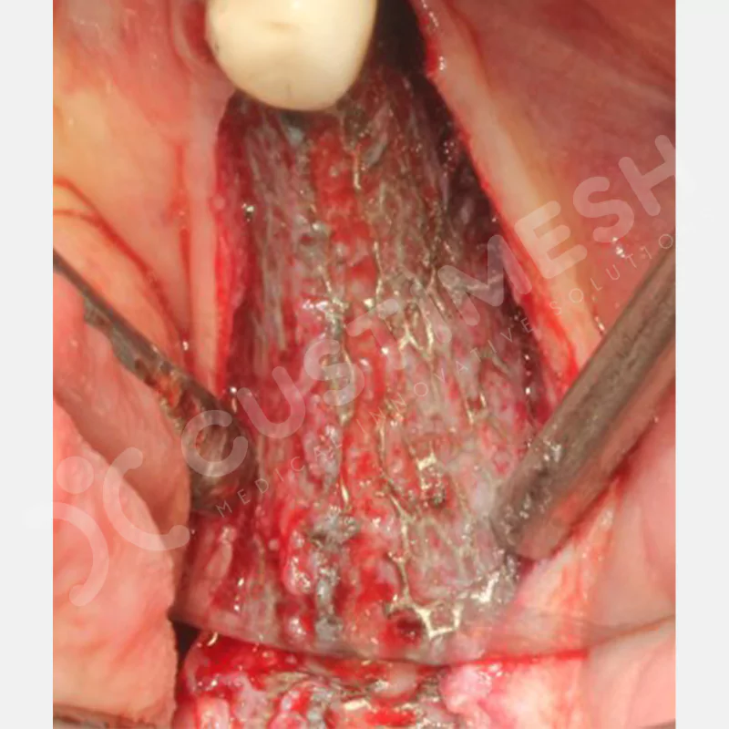 custimesh-mesh-titaniummesh-vaka1-29