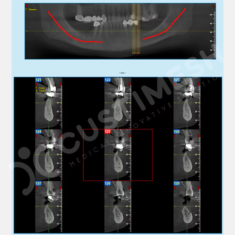 custimesh-mesh-titaniummesh-vaka1-3