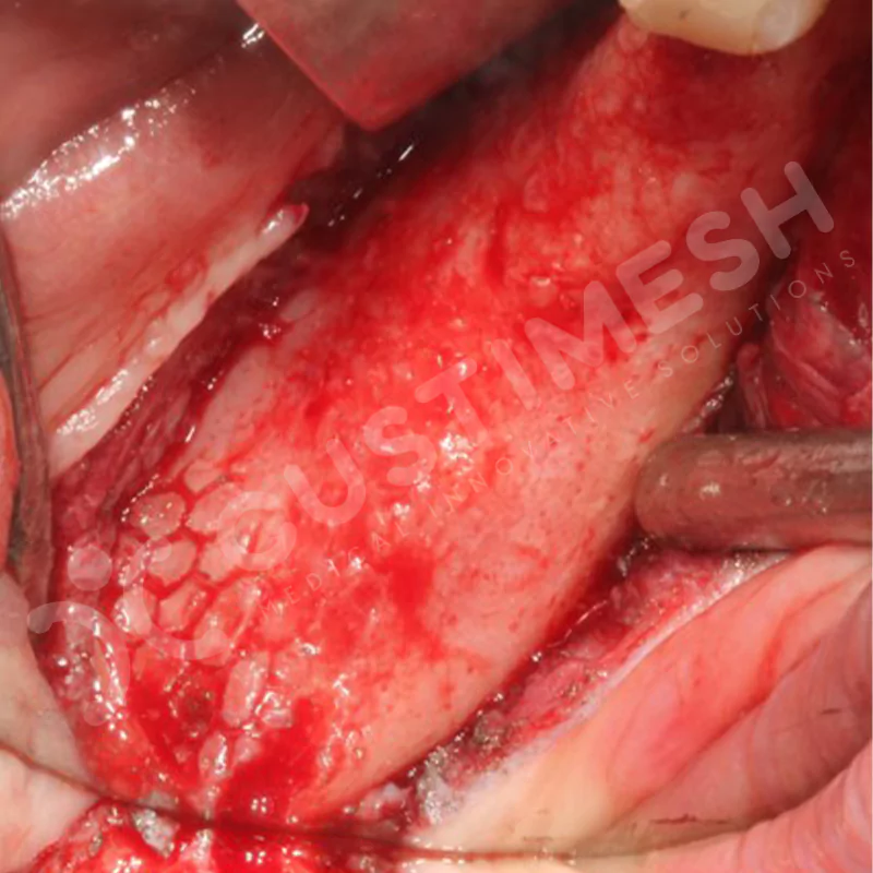 custimesh-mesh-titaniummesh-vaka1-30