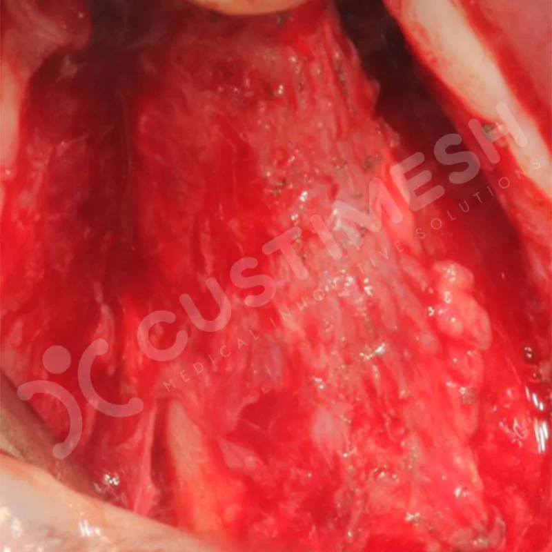 custimesh-mesh-titaniummesh-vaka1-31