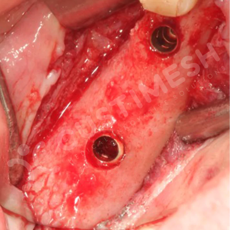 custimesh-mesh-titaniummesh-vaka1-32