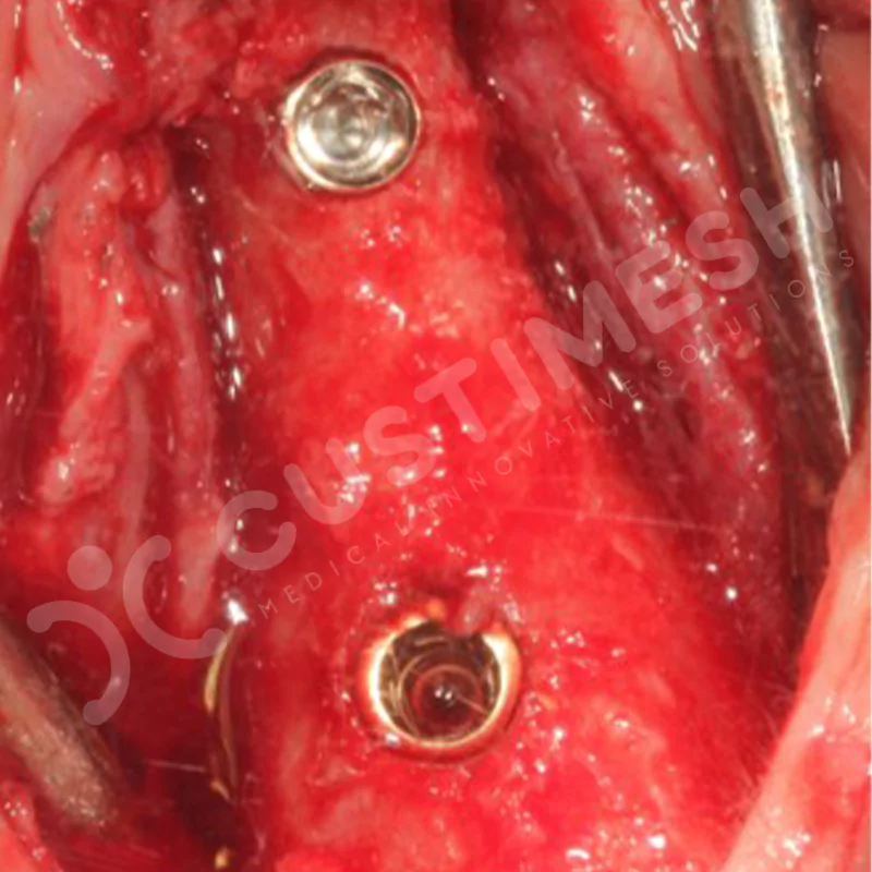 custimesh-mesh-titaniummesh-vaka1-33