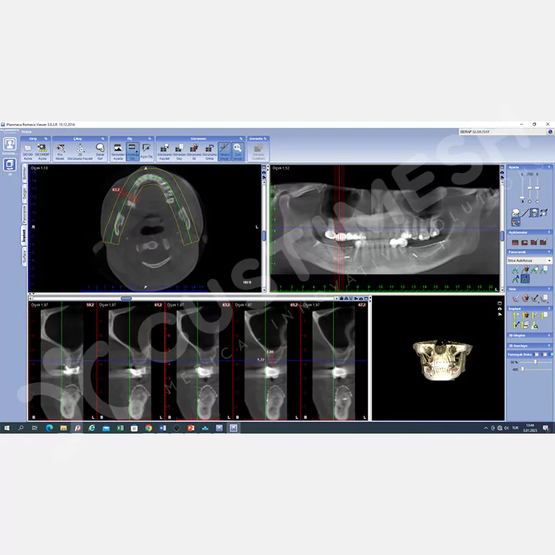 custimesh-mesh-titaniummesh-vaka1-34