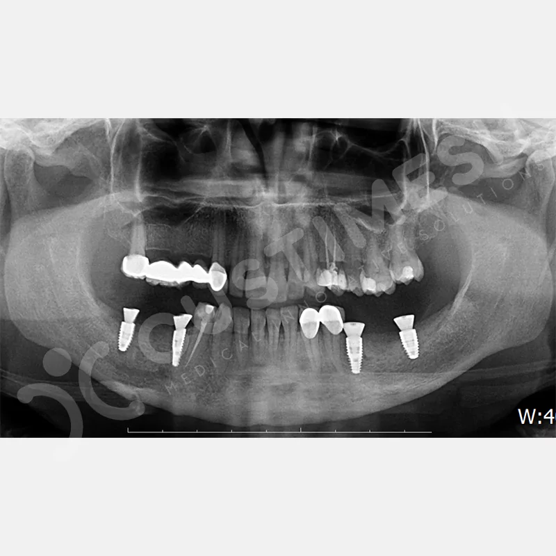 custimesh-mesh-titaniummesh-vaka1-36