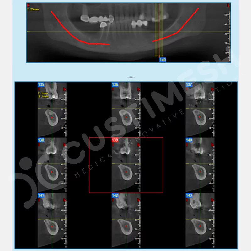 custimesh-mesh-titaniummesh-vaka1-4