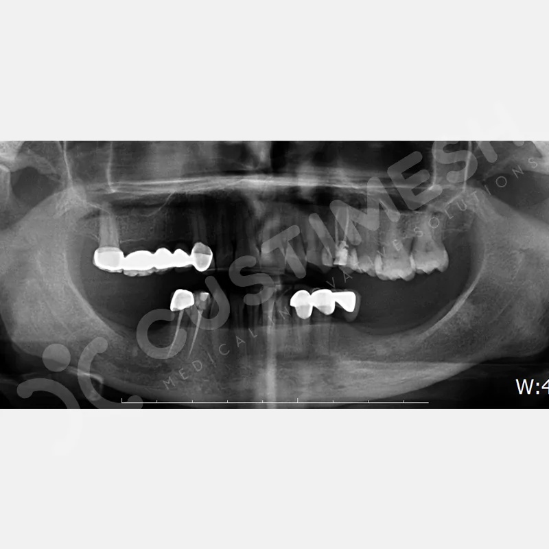 custimesh-mesh-titaniummesh-vaka1-5