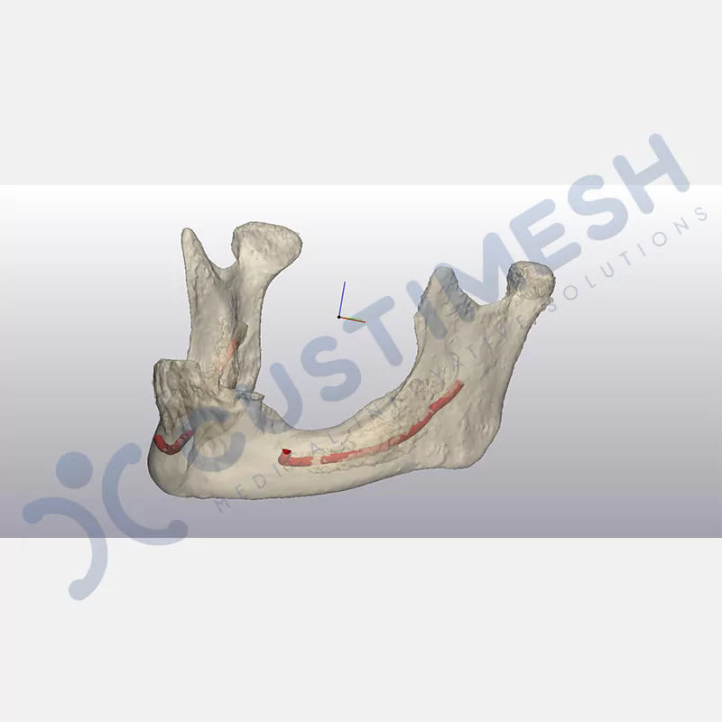 custimesh-mesh-titaniummesh-vaka1-8