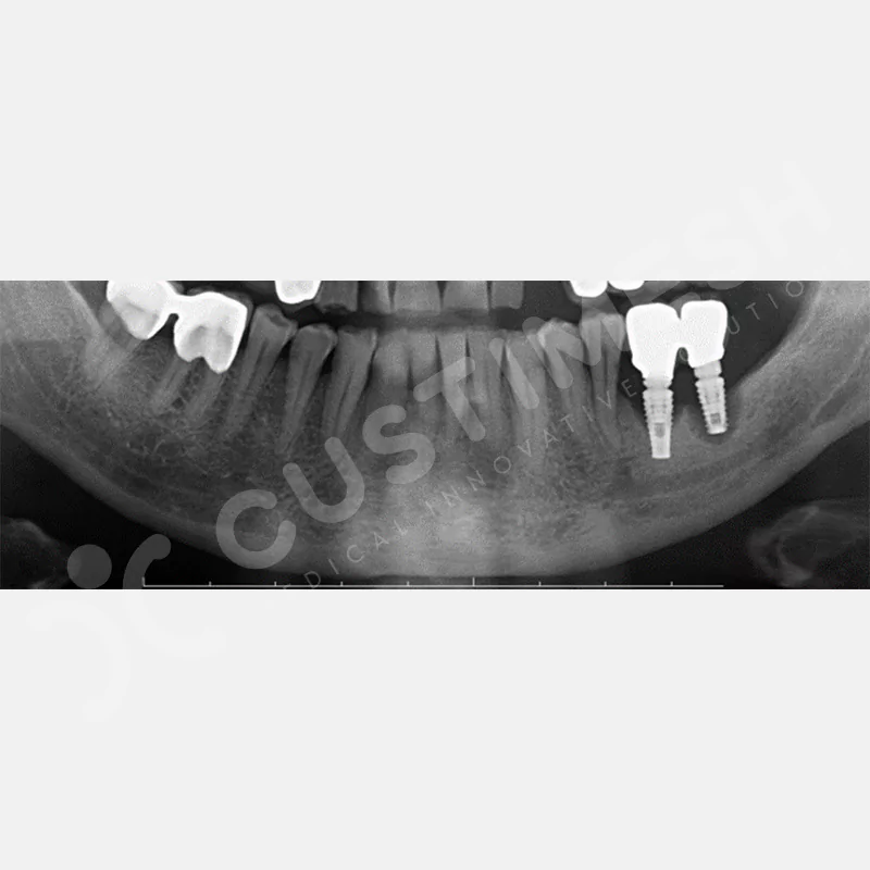 custimesh-mesh-titaniummesh-vaka2-1