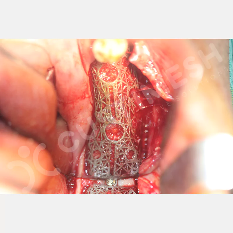 custimesh-mesh-titaniummesh-vaka2-10