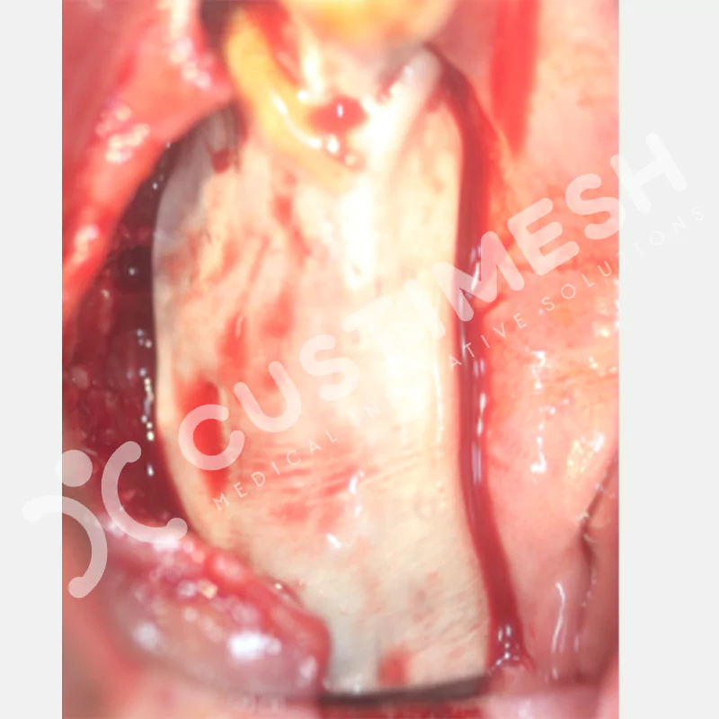 custimesh-mesh-titaniummesh-vaka2-11