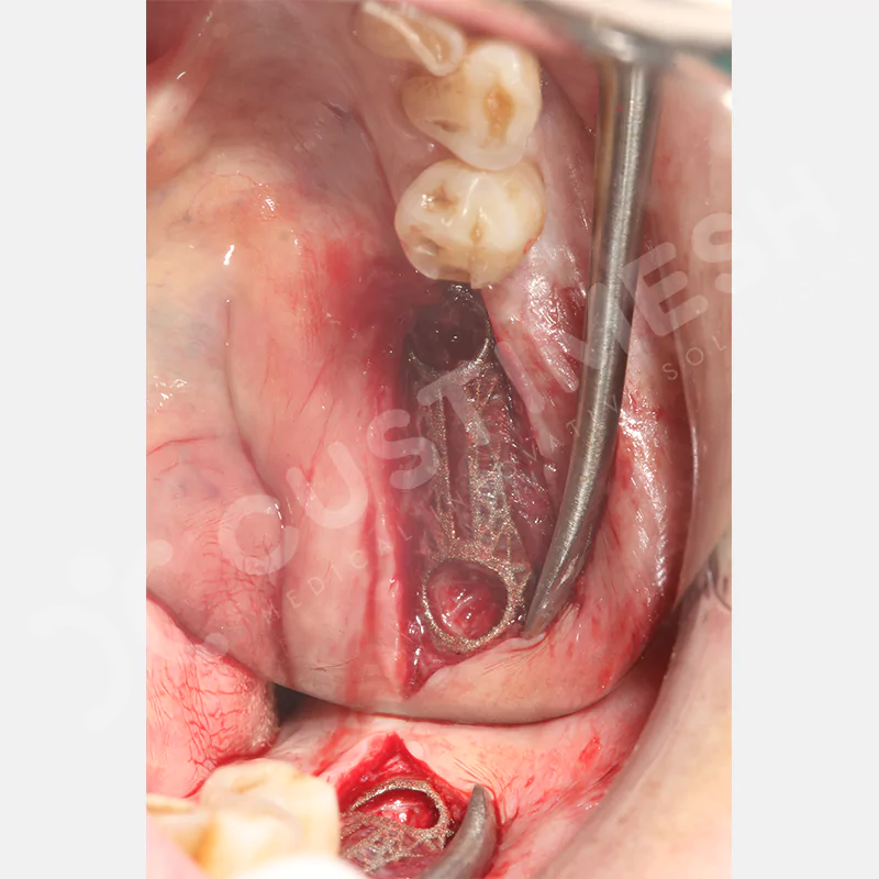 custimesh-mesh-titaniummesh-vaka2-12