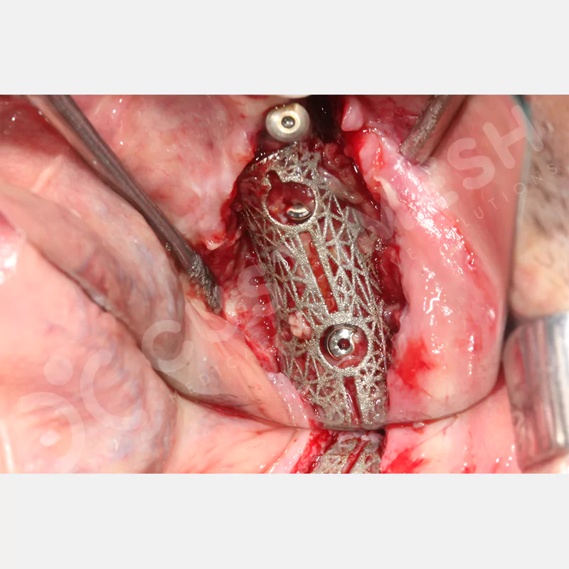 custimesh-mesh-titaniummesh-vaka2-13