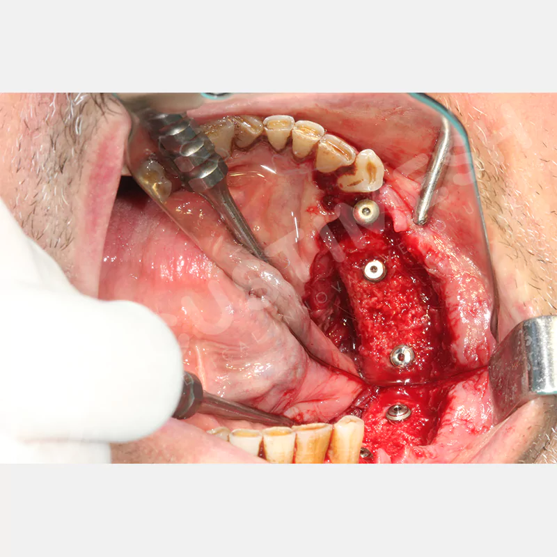 custimesh-mesh-titaniummesh-vaka2-14