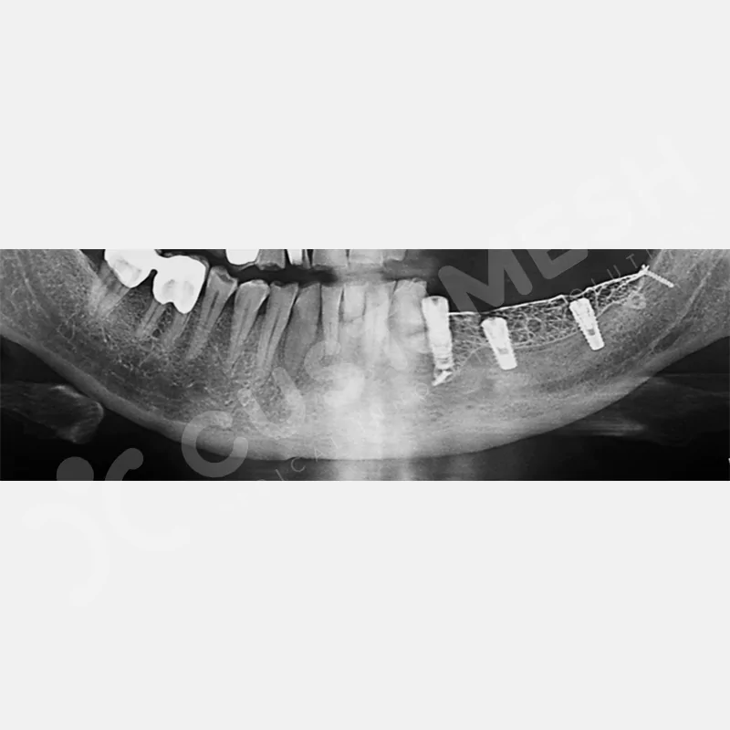 custimesh-mesh-titaniummesh-vaka2-15