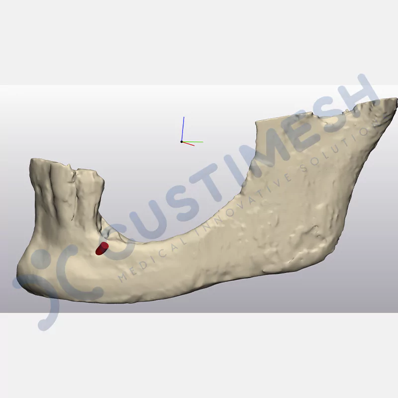 custimesh-mesh-titaniummesh-vaka2-2