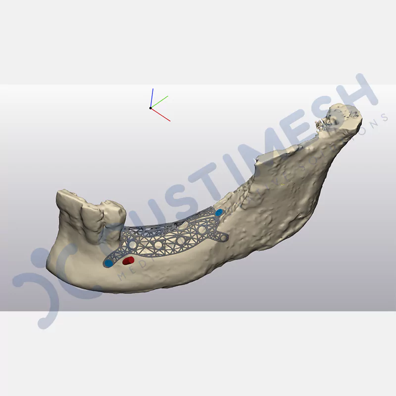 custimesh-mesh-titaniummesh-vaka2-3