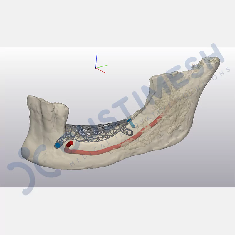 custimesh-mesh-titaniummesh-vaka2-5