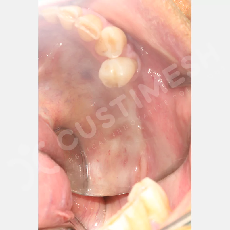 custimesh-mesh-titaniummesh-vaka2-6