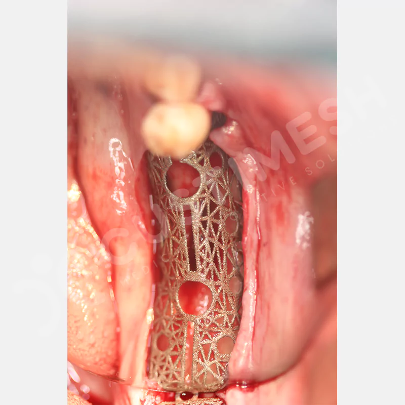 custimesh-mesh-titaniummesh-vaka2-7