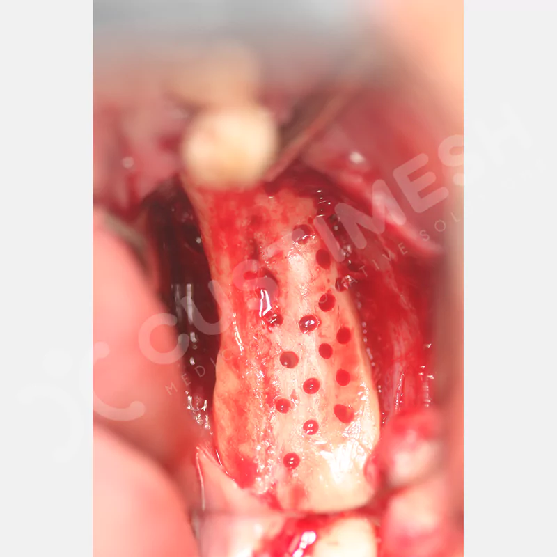 custimesh-mesh-titaniummesh-vaka2-8