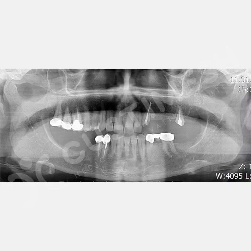 custimesh-mesh-titaniummesh-vaka3-1