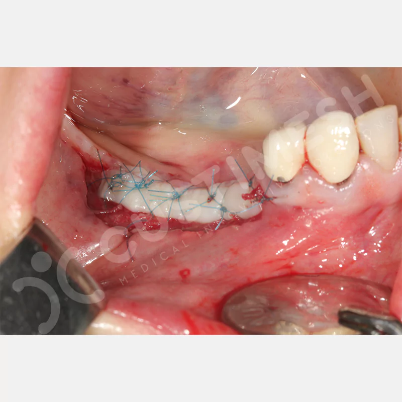 custimesh-mesh-titaniummesh-vaka3-10