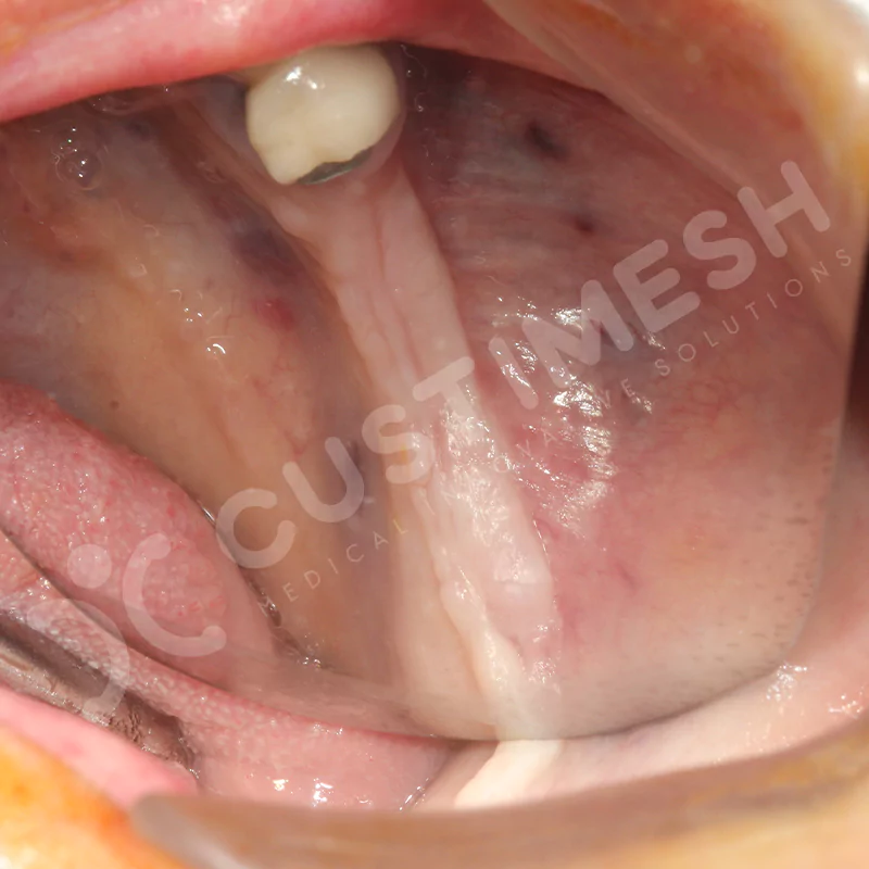 custimesh-mesh-titaniummesh-vaka3-12