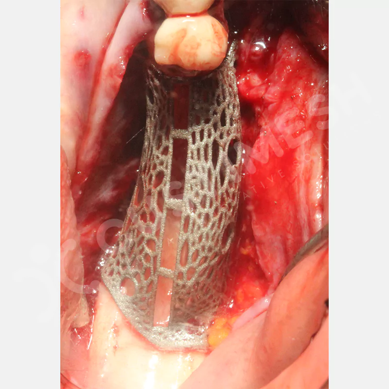 custimesh-mesh-titaniummesh-vaka3-13