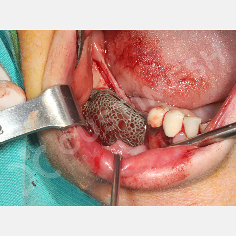 custimesh-mesh-titaniummesh-vaka3-14