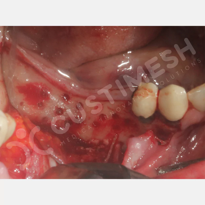 custimesh-mesh-titaniummesh-vaka3-15