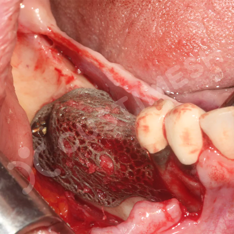 custimesh-mesh-titaniummesh-vaka3-17