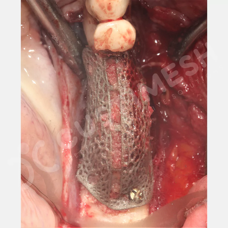 custimesh-mesh-titaniummesh-vaka3-18