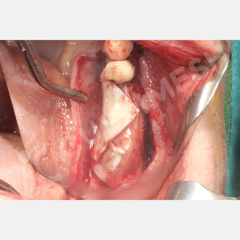 custimesh-mesh-titaniummesh-vaka3-19